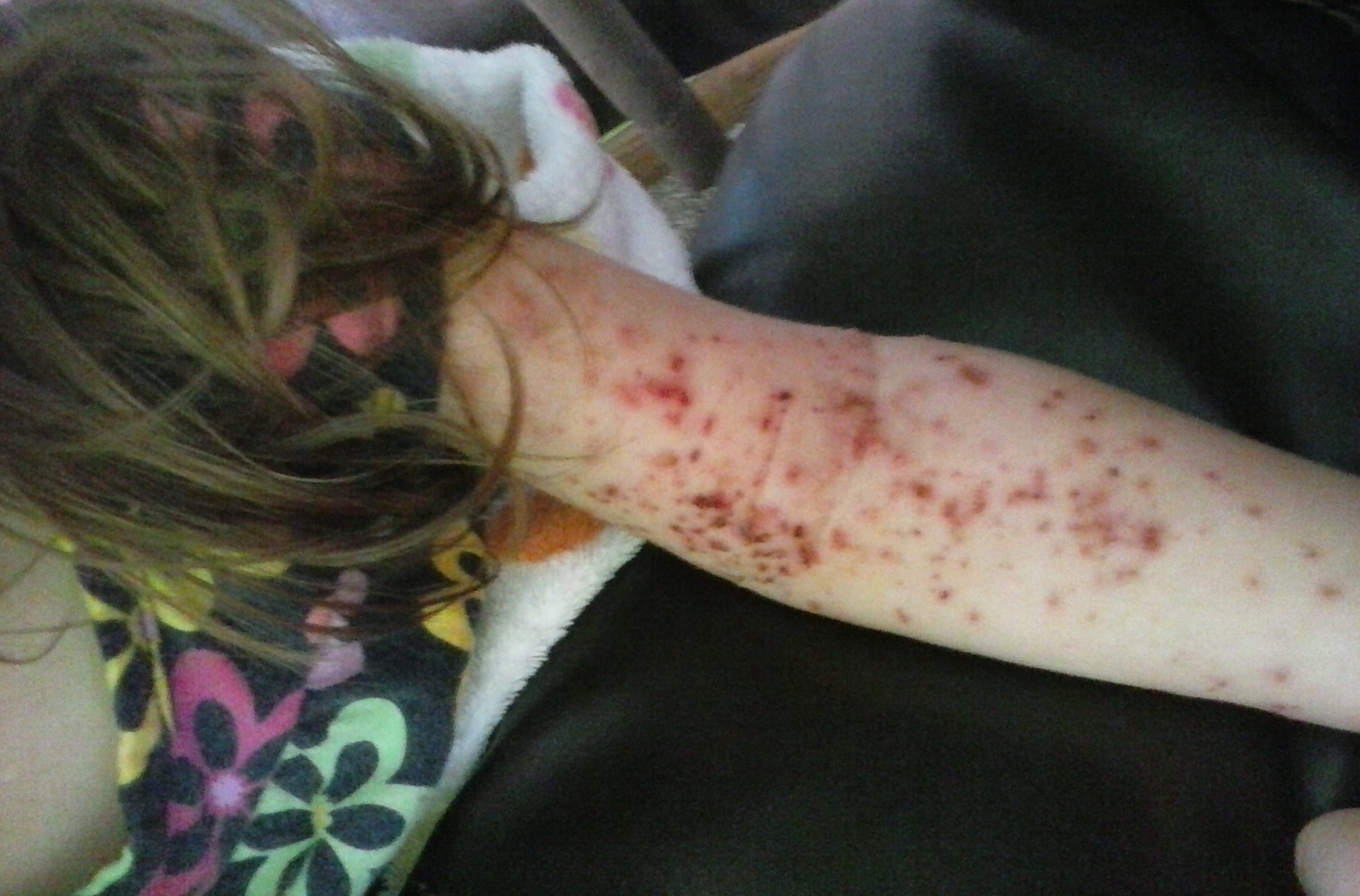 female skin rash before naet treatments